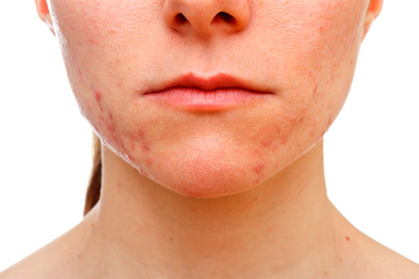 acné, marcas de acné